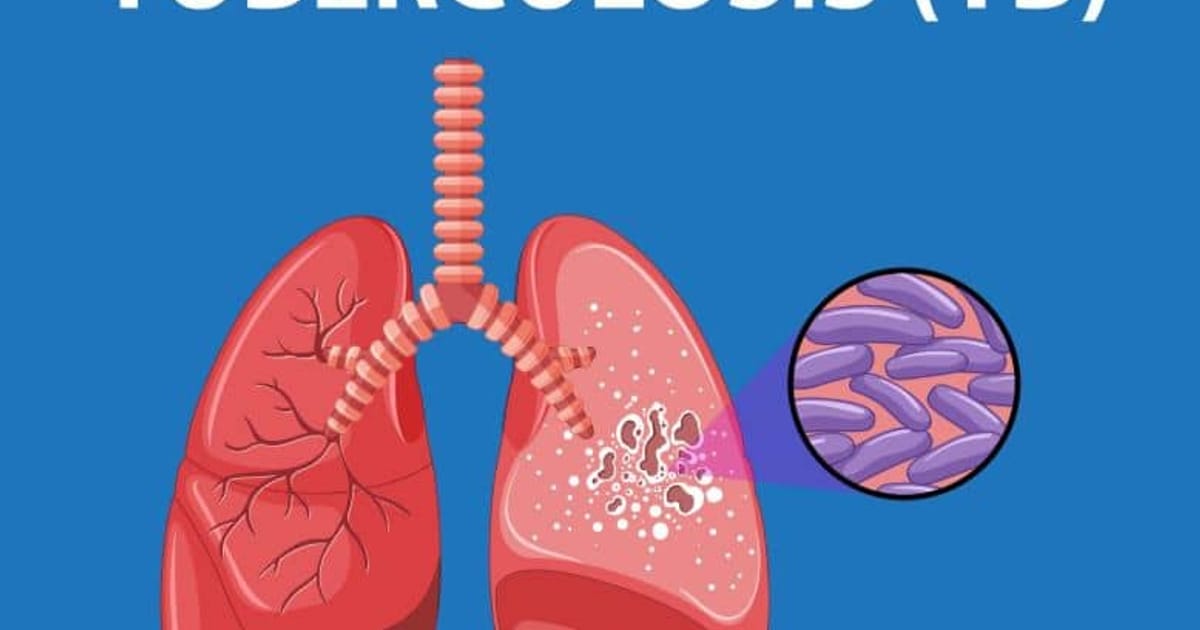 TB Resisten Obat Serang Tasikmalaya: 18 Pasien dari 1.239 Kasus Positif